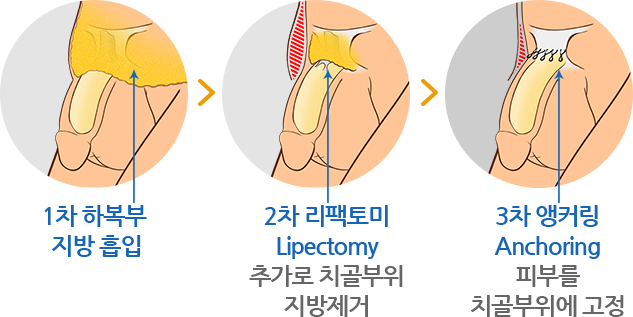 1차 하복부 지방 흡입 / 2차 리팩토미 Lipectomy 추가로 치골부위 지방제거 / 3차 앵커링 Anchoring 피부를 치골부위에 고정