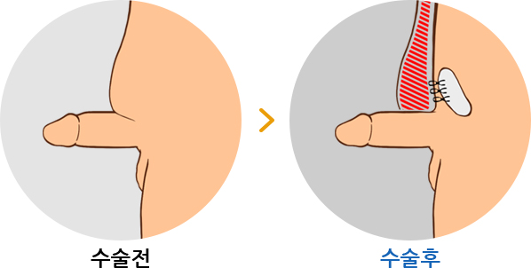 하이맨 고도함몰음경 교정 길이연장술 전 /후